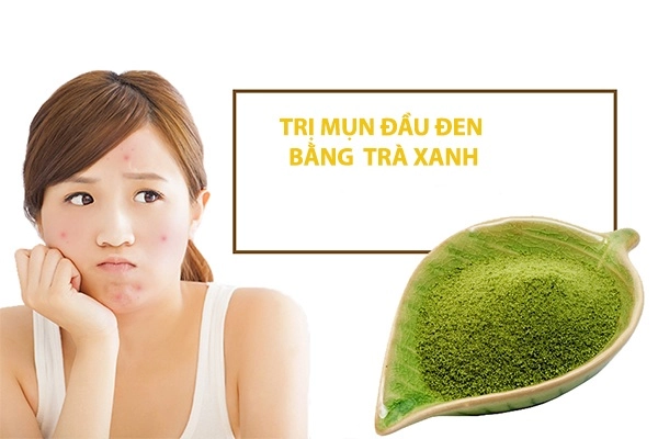 Cách trị mụn đầu đen tại nhà hiệu quả để có làn da trắng sáng mịn màng - 8