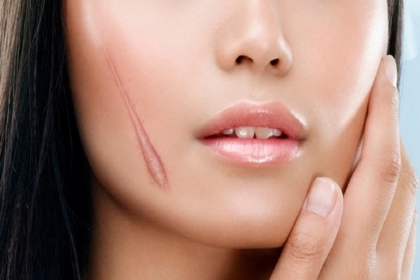 Cách trị sẹo lồi bằng các phương pháp tự nhiên an toàn hiệu quả nhanh nhất - 1
