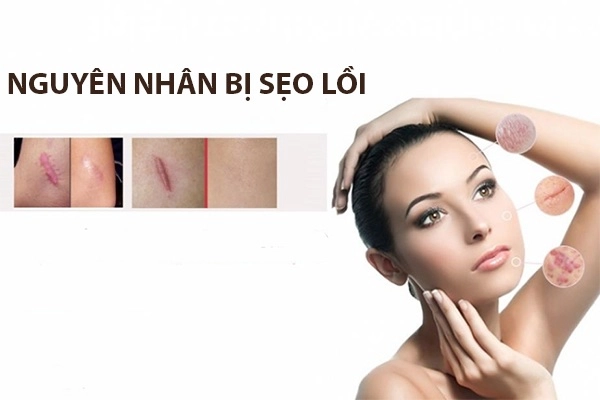 Cách trị sẹo lồi bằng các phương pháp tự nhiên an toàn hiệu quả nhanh nhất - 2