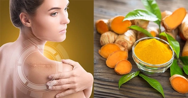 Cách trị sẹo lồi bằng các phương pháp tự nhiên an toàn hiệu quả nhanh nhất - 3