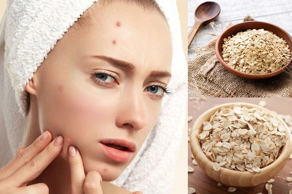Cách trị thâm mụn tại nhà nhanh nhất an toàn và dễ dàng thực hiện - 3