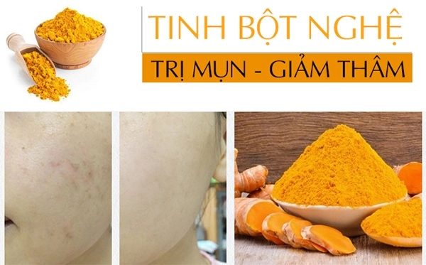 Cách trị thâm mụn tại nhà nhanh nhất an toàn và dễ dàng thực hiện - 6