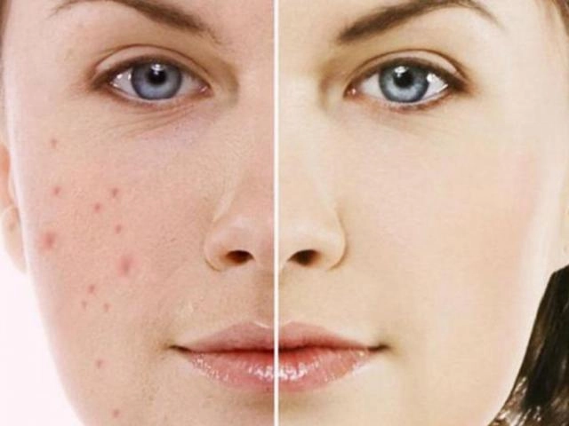 Cách trị thâm mụn tại nhà nhanh nhất an toàn và dễ dàng thực hiện - 9