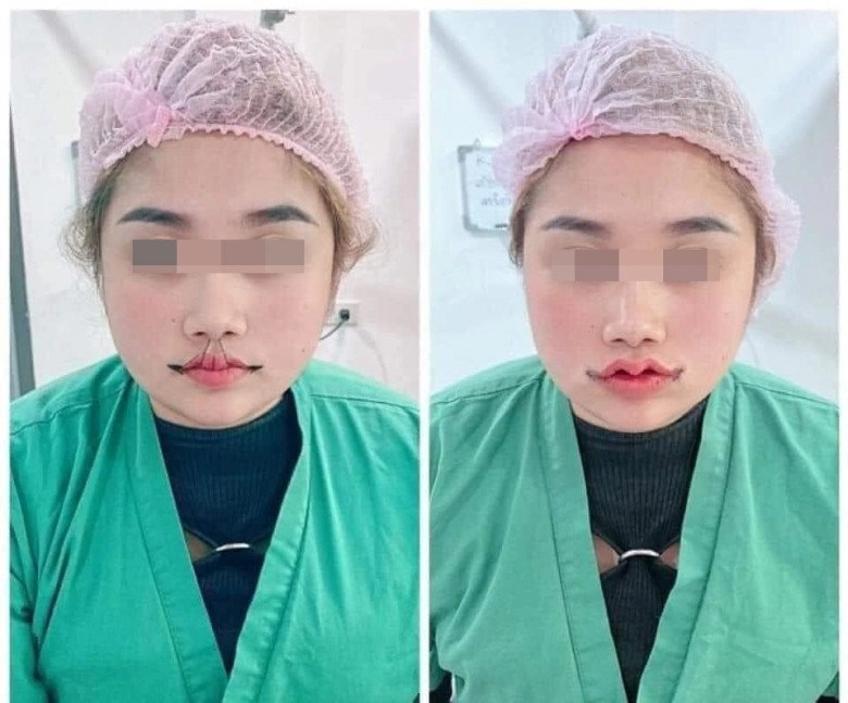 Cắt môi trái tim gái xinh nhận về đôi môi như củ ấu có ca còn như cửa không cánh - 2