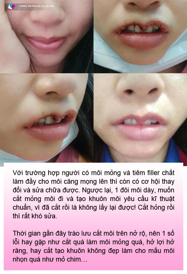 Cắt môi trái tim gái xinh nhận về đôi môi như củ ấu có ca còn như cửa không cánh - 5