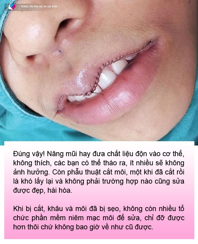 Cắt môi trái tim gái xinh nhận về đôi môi như củ ấu có ca còn như cửa không cánh - 6