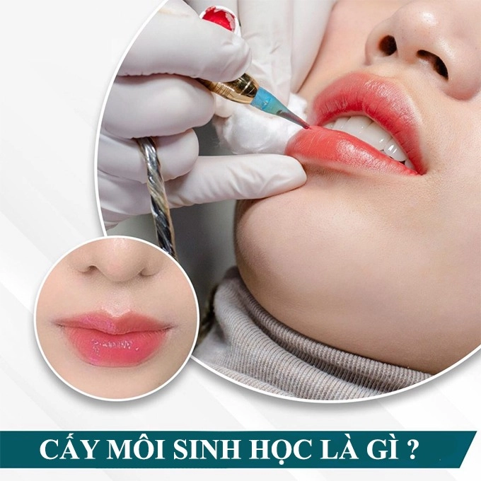 Cấy môi sinh học là gì chuyên gia nói gì về phương pháp cấy hồng môi khử thâm - 2