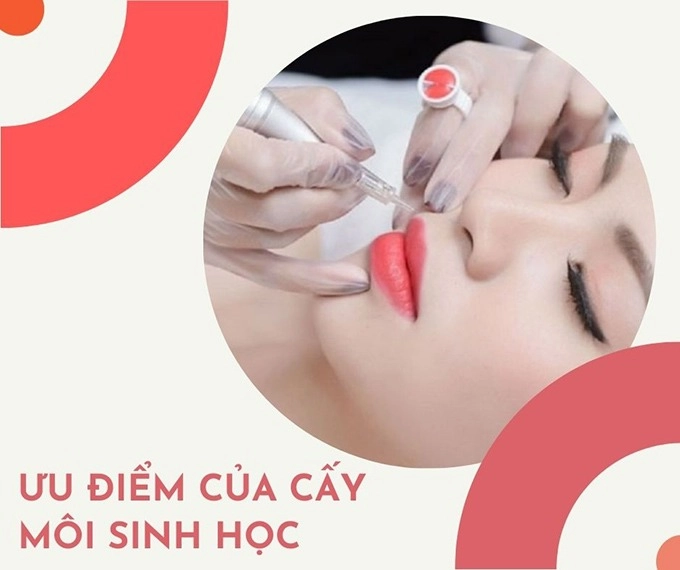 Cấy môi sinh học là gì chuyên gia nói gì về phương pháp cấy hồng môi khử thâm - 3