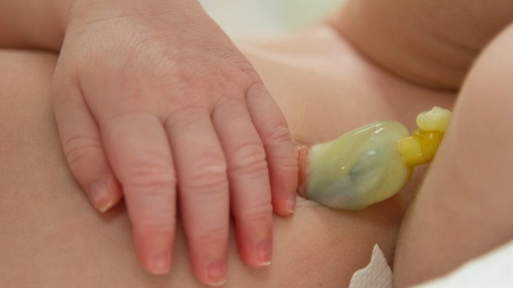 Chăm sóc trẻ sơ sinh rụng rốn nhưng chưa khô - 1