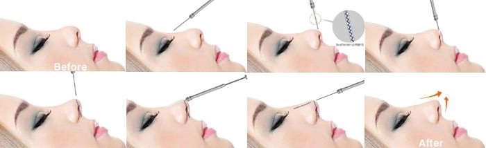 Chân dài xinh đẹp vẫn sợ lão hoá làm mũi collagen để luôn tươi trẻ - 20