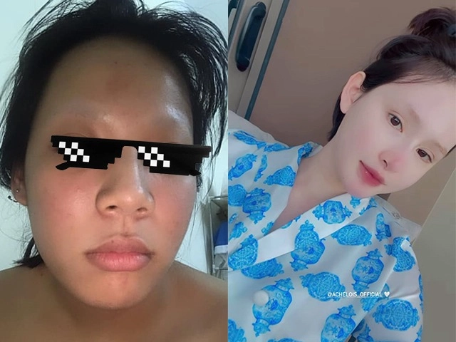 Ái nữ đại gia ngọc thanh tâm tự mua kim nặn mụn làn da nhận cái kết đắng - 12