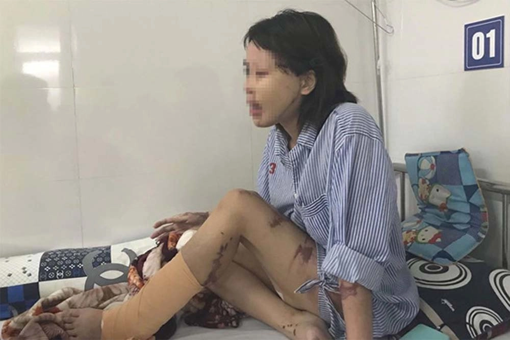 Cô gái bị chồng sắp cưới tạt axit nửa khuôn mặt giờ lột xác với diện mạo không nhận ra - 1