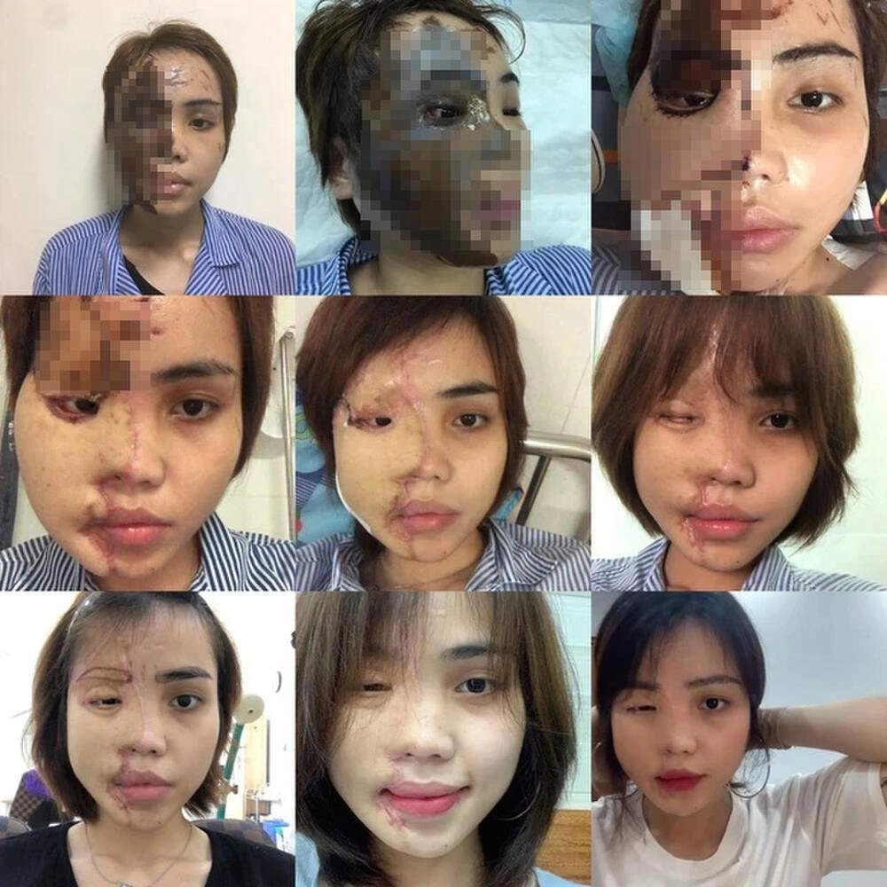 Cô gái bị chồng sắp cưới tạt axit nửa khuôn mặt giờ lột xác với diện mạo không nhận ra - 2