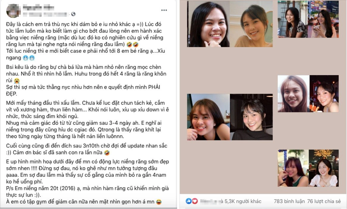Cô gái dằn mặt người yêu cũ khi gỡ bỏ 8 chiếc răng từ vịt hoá thiên nga - 1