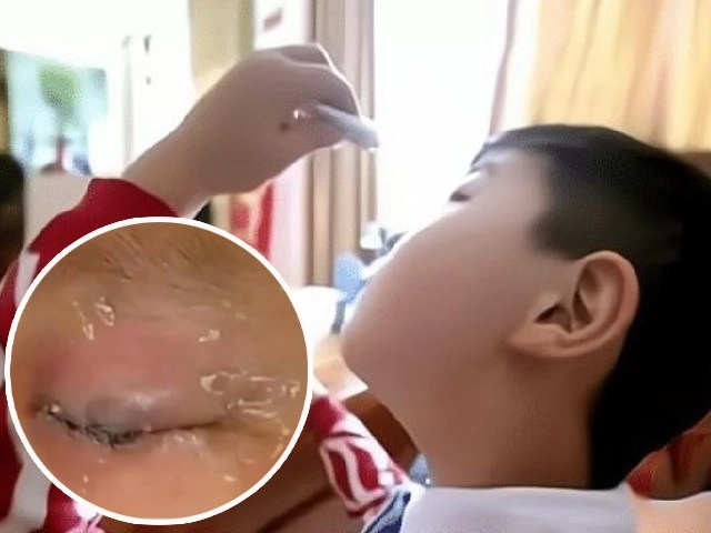 Con 2 tuổi cắn vỡ nhiệt kế thủy ngân mẹ đổ vội nước này vào miệng cứu sống bé - 3