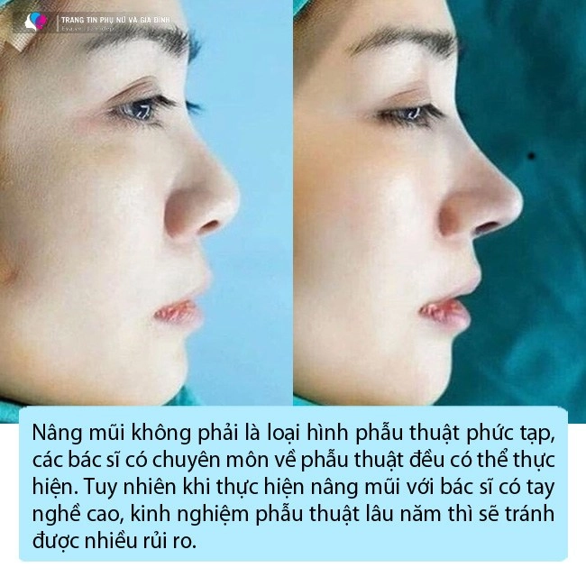 Công nghệ nâng mũi giờ đã khác ai đang có ý định thẩm mỹ đọc ngay bài viết này - 2