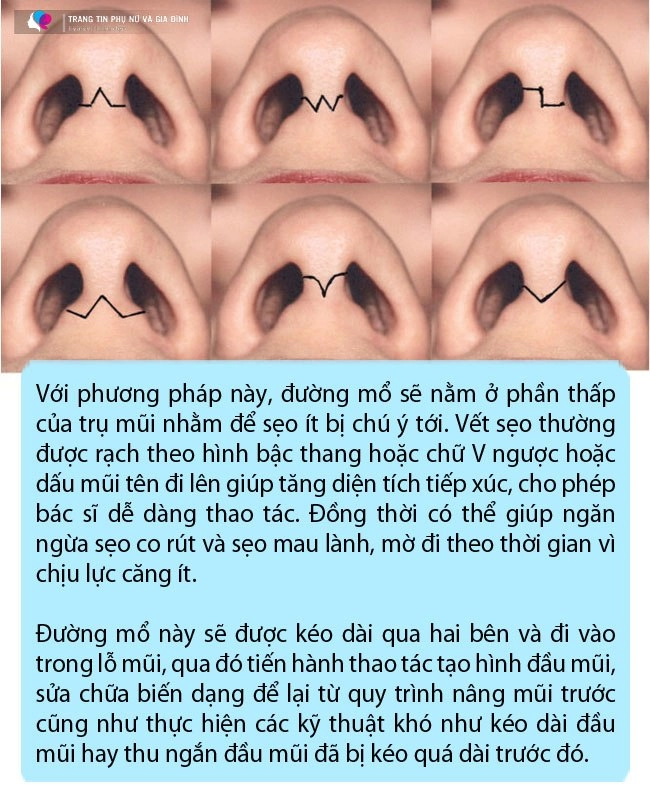 Công nghệ nâng mũi giờ đã khác ai đang có ý định thẩm mỹ đọc ngay bài viết này - 3