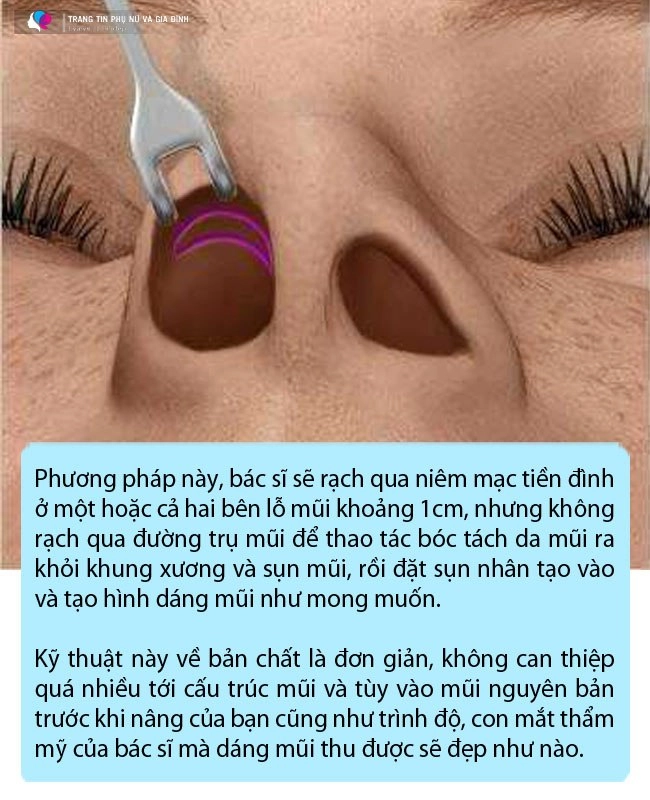 Công nghệ nâng mũi giờ đã khác ai đang có ý định thẩm mỹ đọc ngay bài viết này - 4