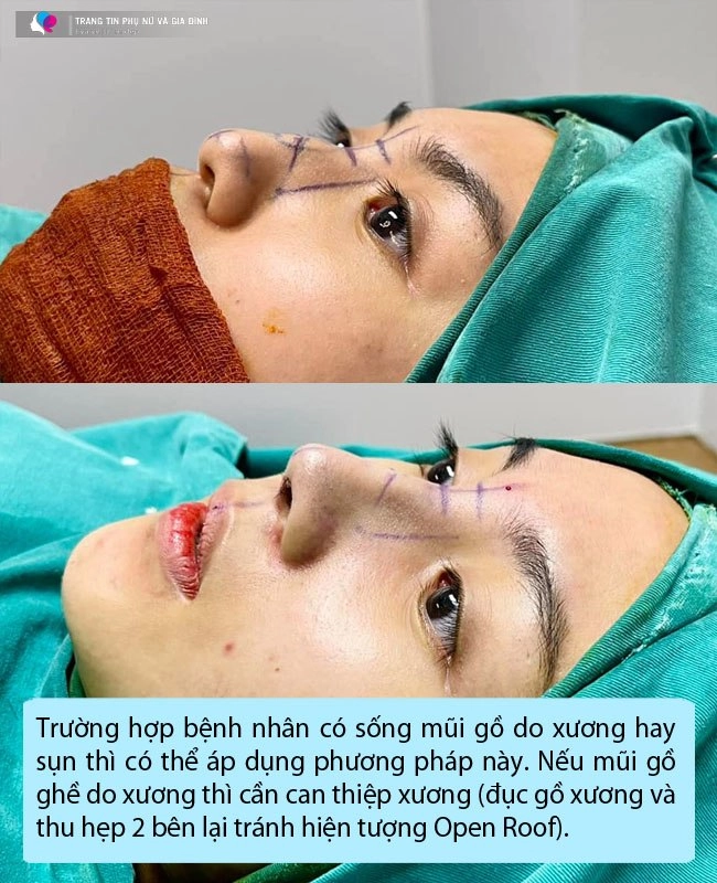 Công nghệ nâng mũi giờ đã khác ai đang có ý định thẩm mỹ đọc ngay bài viết này - 6