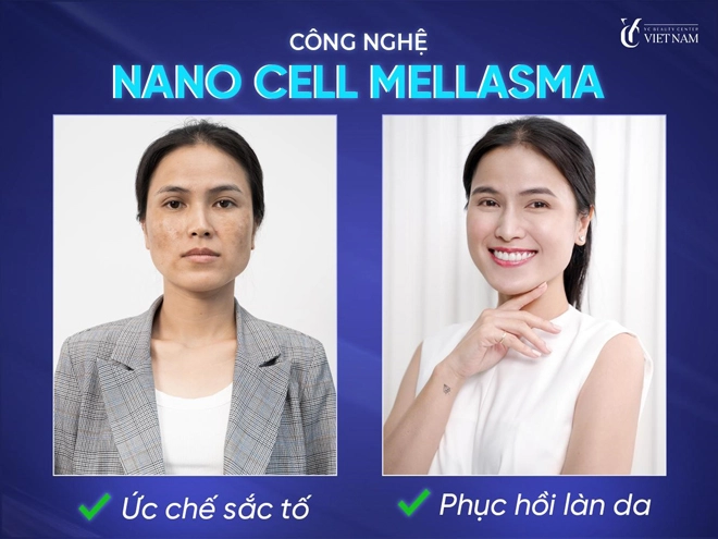 Công nghệ trị nám nanocell melasma - vực dậy niềm tin chữa nám cho hàng triệu chị em - 1