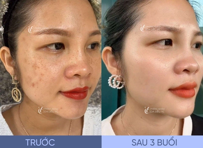 Công nghệ trị nám nanocell melasma - vực dậy niềm tin chữa nám cho hàng triệu chị em - 5