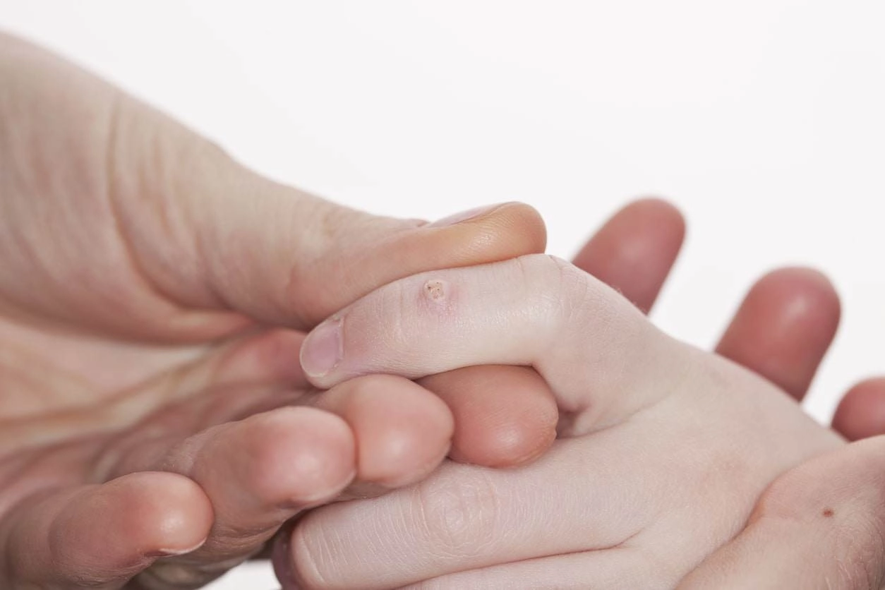 Da sáng láng mịn với những bí quyết trị mụn cơm siêu đơn giản nhưng vô cùng hiệu quả - 3