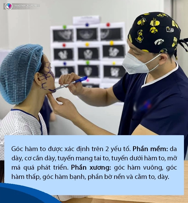 Đang niềng răng có gọt xương hàm hạ gò má hay trượt cằm được không - 3