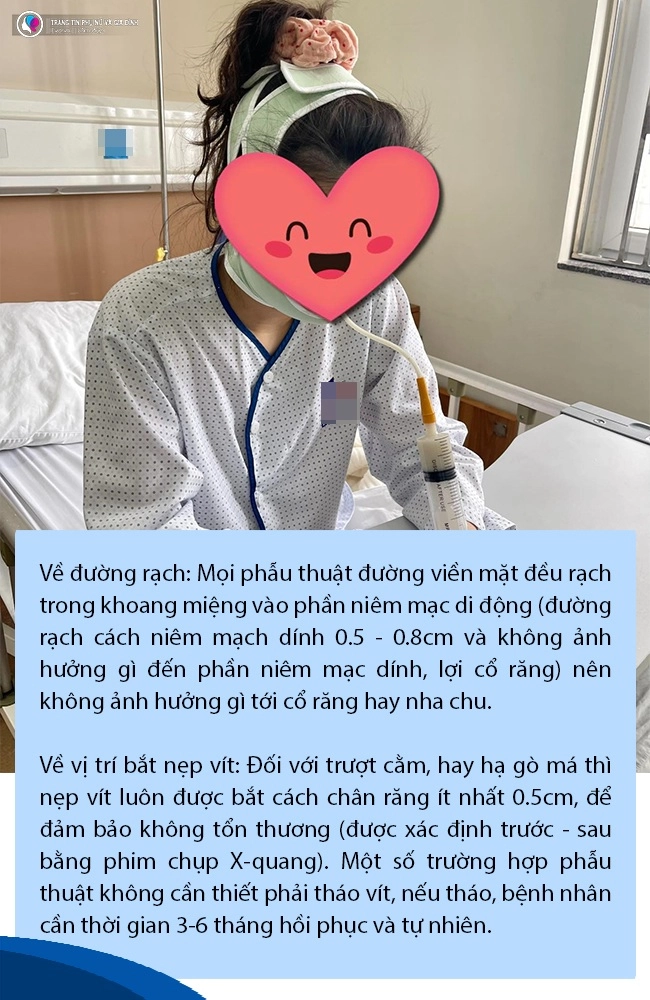 Đang niềng răng có gọt xương hàm hạ gò má hay trượt cằm được không - 7