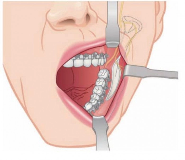 Đang niềng răng có gọt xương hàm hạ gò má hay trượt cằm được không - 8