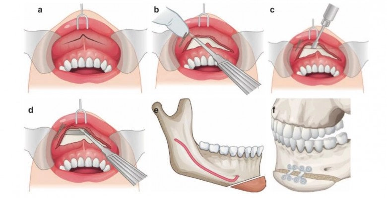 Đang niềng răng có gọt xương hàm hạ gò má hay trượt cằm được không - 9