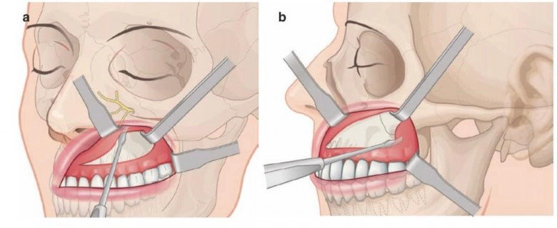 Đang niềng răng có gọt xương hàm hạ gò má hay trượt cằm được không - 10