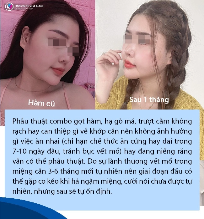 Đang niềng răng có gọt xương hàm hạ gò má hay trượt cằm được không - 12