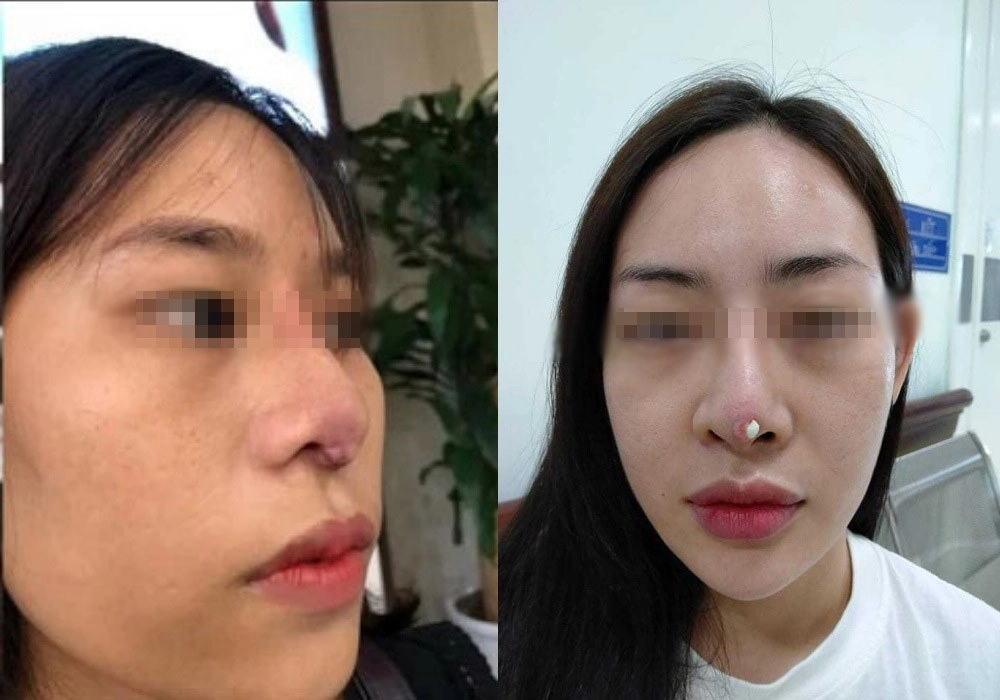 Dao kéo hỏng cái khổ của bệnh nhân và cái khó của bác sĩ - 3