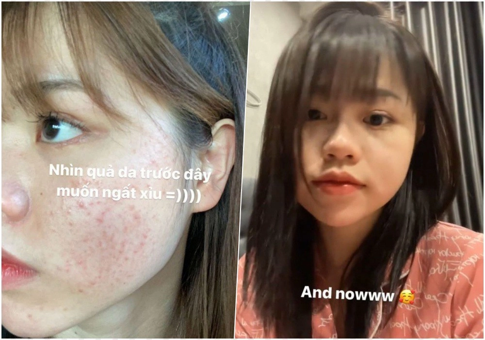 Dậy thì thành công tình cũ quang hải tạm biệt da đen nhẻm dáng gầy nhom - 6