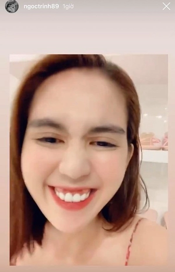 Đẹp lên nhờ răng sứ nhưng ngọc trinh lại có hố đen mất thẩm mỹ ở chân răng - 5