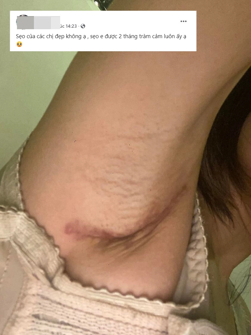 Đi nâng ngực gái xinh khóc thét vì đường rạch nách xấu sẹo dài nửa bàn tay - 2