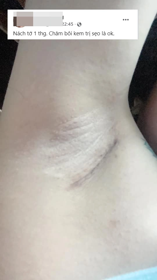 Đi nâng ngực gái xinh khóc thét vì đường rạch nách xấu sẹo dài nửa bàn tay - 5