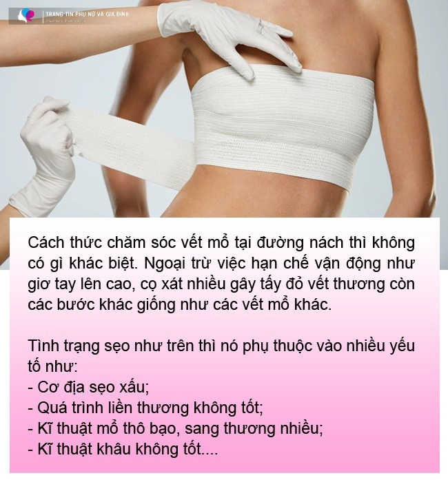 Đi nâng ngực gái xinh khóc thét vì đường rạch nách xấu sẹo dài nửa bàn tay - 8