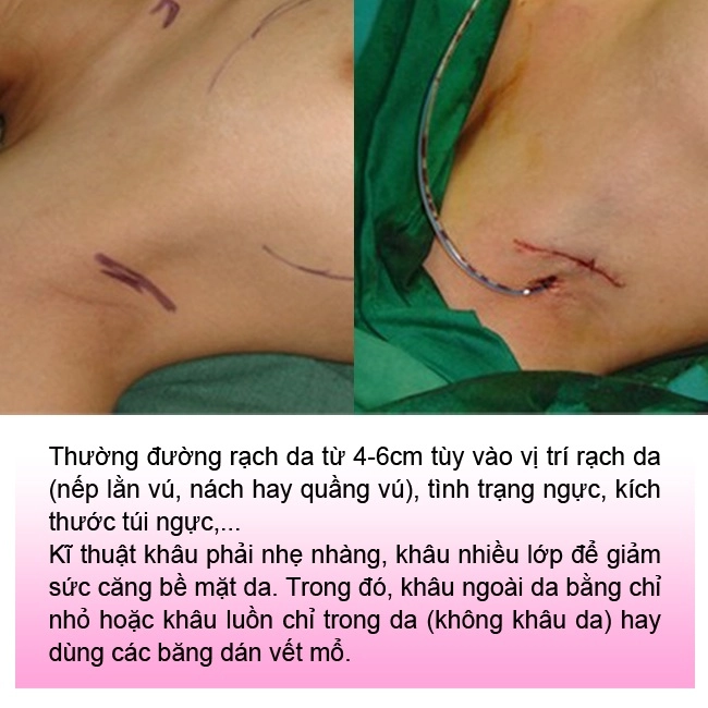 Đi nâng ngực gái xinh khóc thét vì đường rạch nách xấu sẹo dài nửa bàn tay - 9