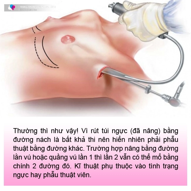 Đi nâng ngực gái xinh khóc thét vì đường rạch nách xấu sẹo dài nửa bàn tay - 10