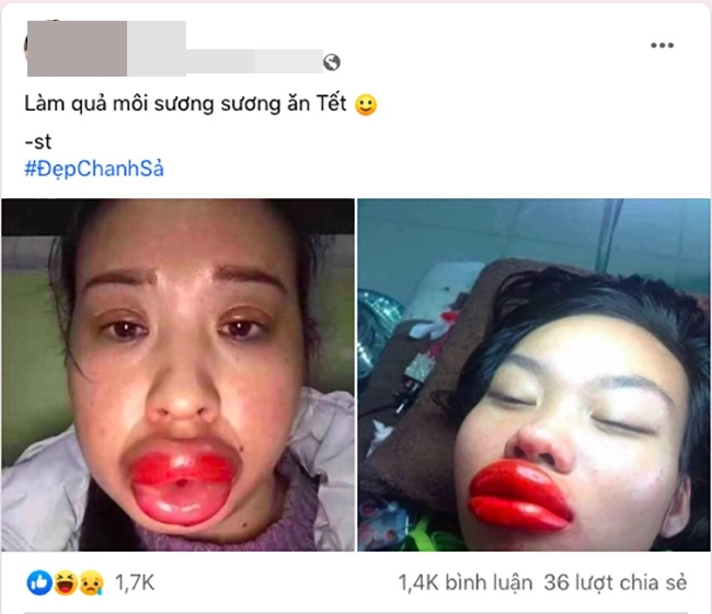 Đi phun môi ăn tết gái xinh số nhọ nhận về cái kết môi sưng như quả chuối mắn - 1