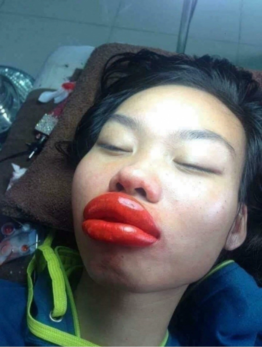 Đi phun môi ăn tết gái xinh số nhọ nhận về cái kết môi sưng như quả chuối mắn - 3