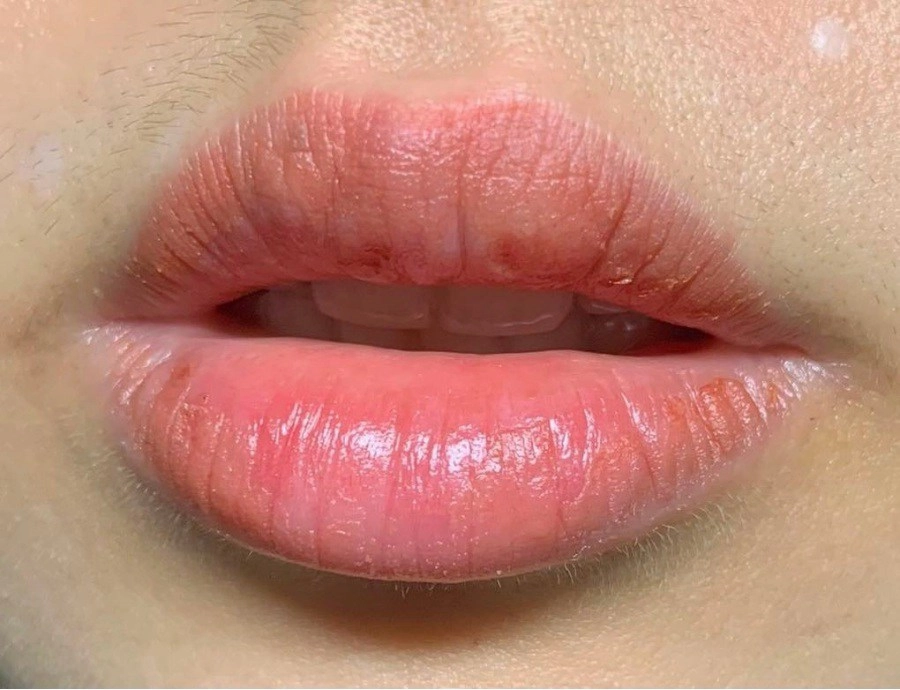 Đi phun môi ăn tết gái xinh số nhọ nhận về cái kết môi sưng như quả chuối mắn - 11