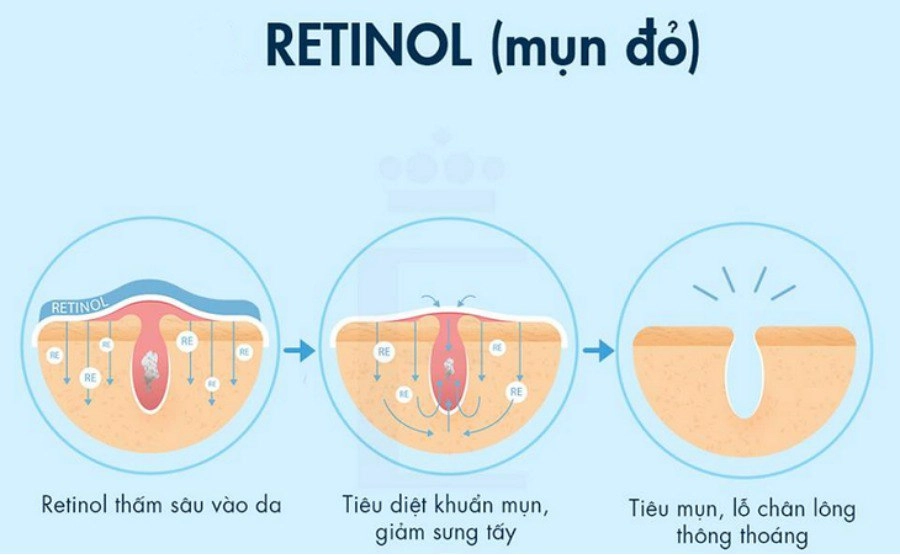 Đỗ thị hà đu trend dùng acid lên mặt da bong tróc nhưng kết quả sau 1 tháng mới phục - 6