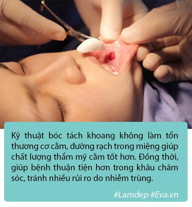 Độn cằm là phương pháp pttm rất đơn giản nhưng tại sao vẫn có nhiều ca biến chứng - 2