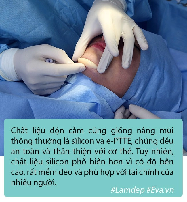 Độn cằm là phương pháp pttm rất đơn giản nhưng tại sao vẫn có nhiều ca biến chứng - 4