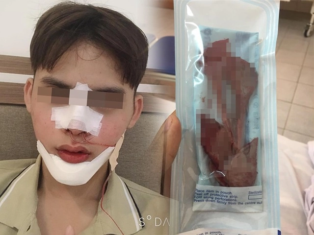 Độn cằm là phương pháp pttm rất đơn giản nhưng tại sao vẫn có nhiều ca biến chứng - 7