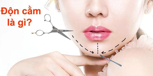 Độn cằm v line là gì độn cằm có đau và nguy hiểm không - 1