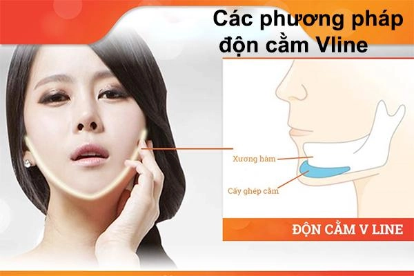 Độn cằm v line là gì độn cằm có đau và nguy hiểm không - 4