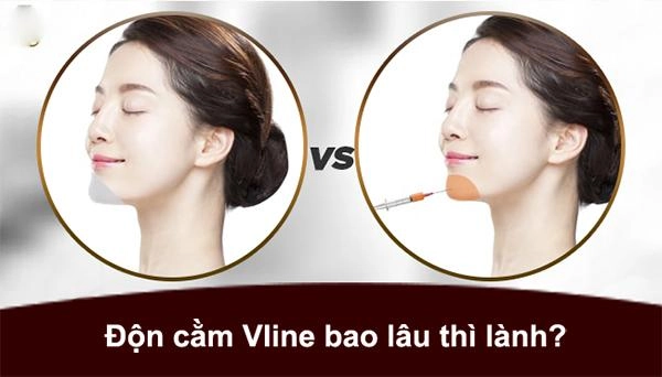 Độn cằm v line là gì độn cằm có đau và nguy hiểm không - 5